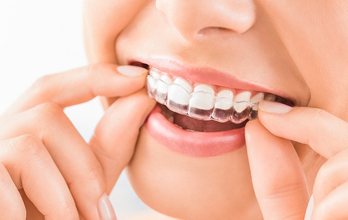 Invisalign can treat crowded teeth in Muskegon, MI