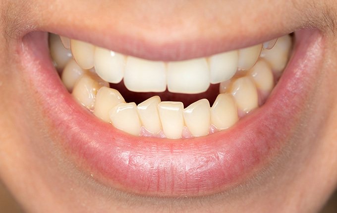 Close up gaps between teeth with Invisalign in Muskegon, MI