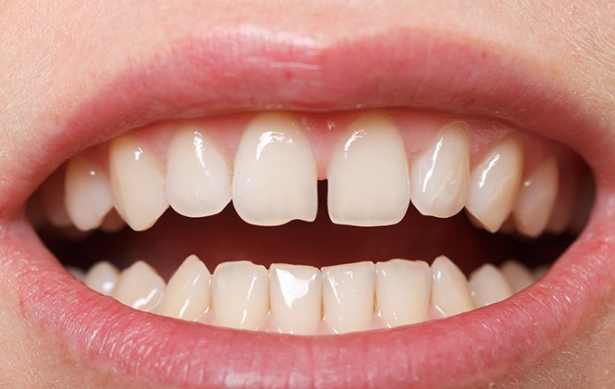 Get better bite alignment with Invisalign in Muskegon, MI