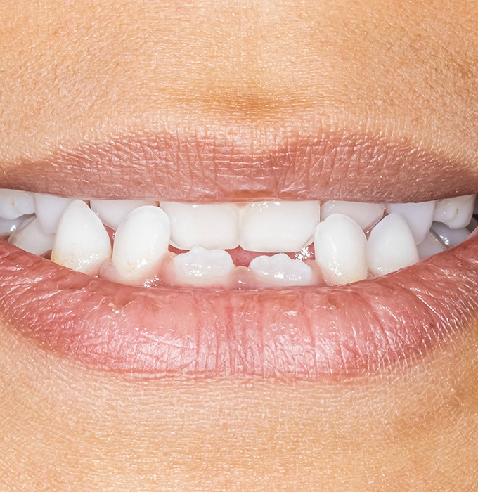 A beautiful smile is a benefit of Invisalign in Muskegon, MI